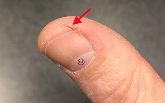 Fotografie palce s kožní prasklinou z detailu se směřující červenou šipkou k prasklině | Rady ze života