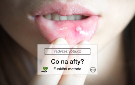 Fotografie ženy s aftem v puse držící rukou otočený spodní ret tak aby byl zanícený aft dobře vidět | Zdroj: shutterstock | Článek "Co na afty" na webových stránkách radyzezivota.cz